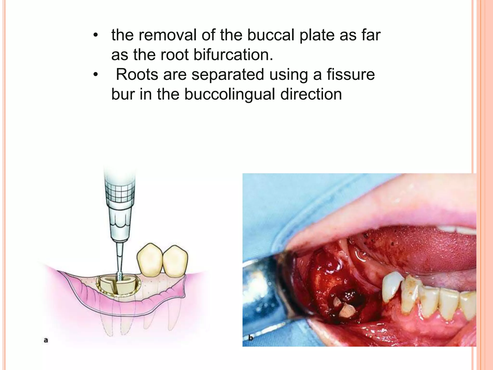 • the removal of the buccal plate as far
as the root bifurcation.
• Roots are separated using a fissure
bur in the buccolingual direction
 