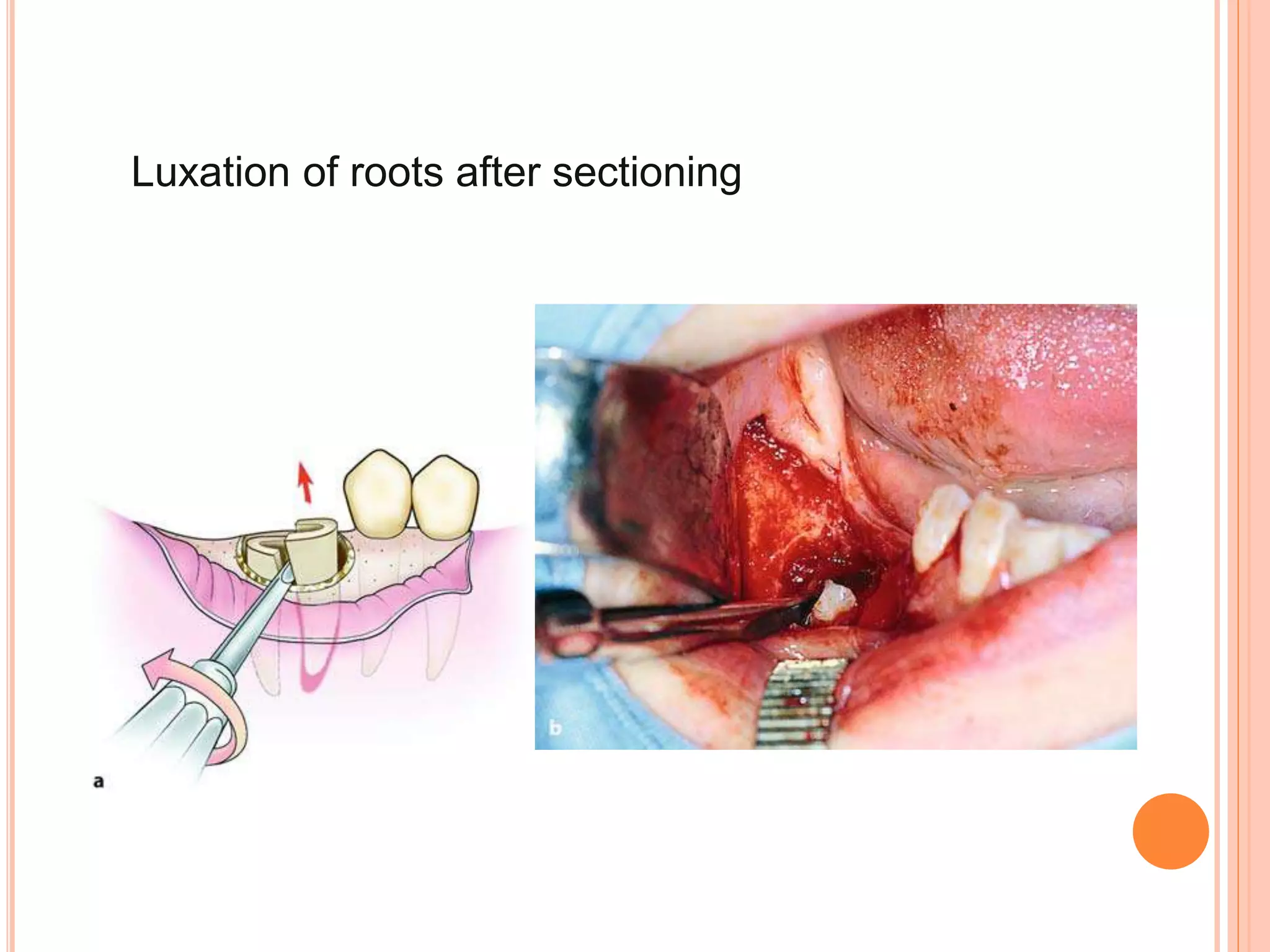 Luxation of roots after sectioning
 