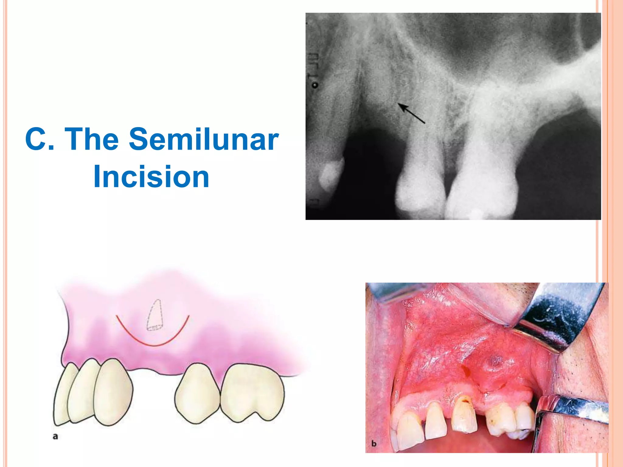 C. The Semilunar
Incision
 