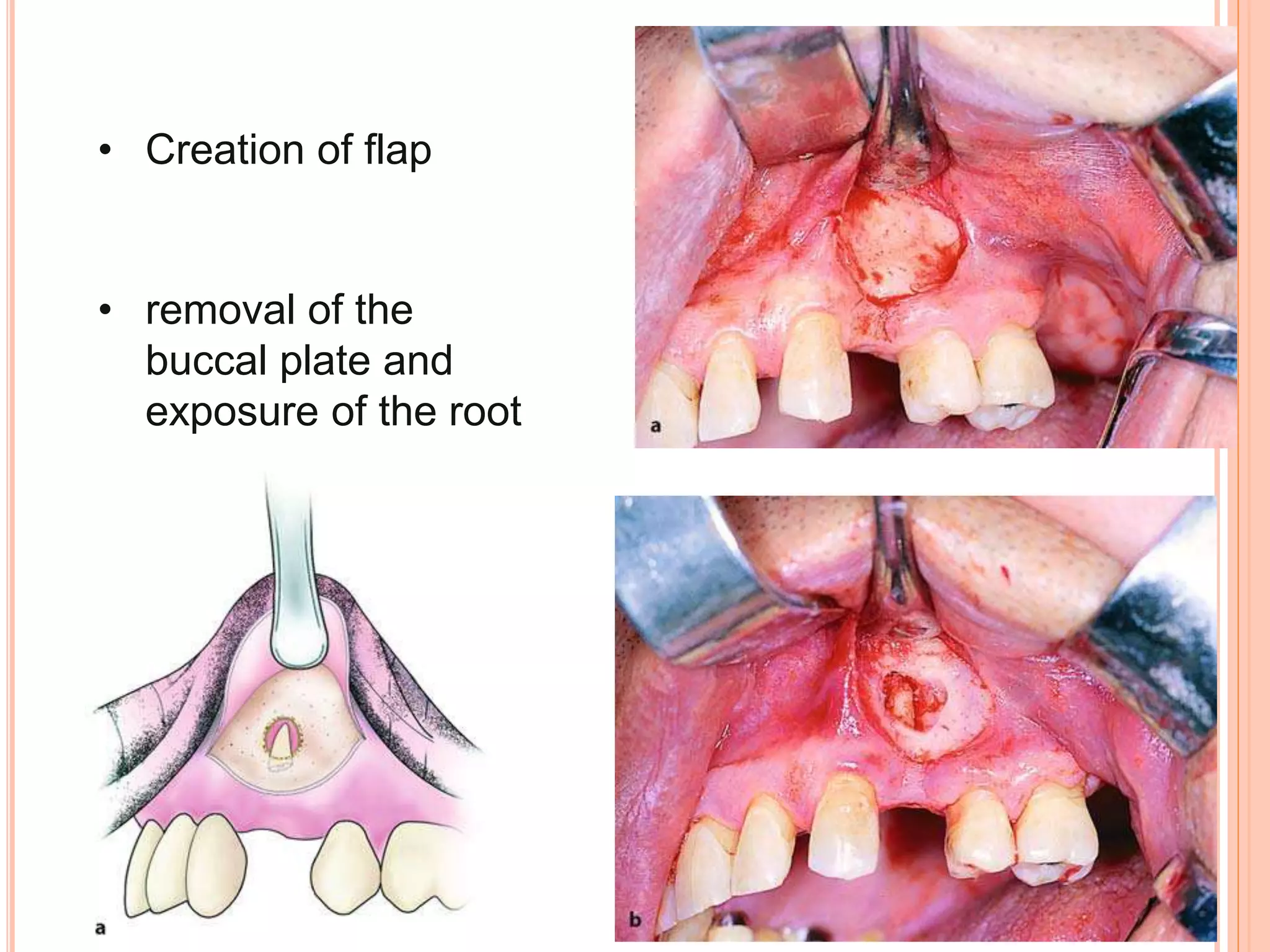 • Creation of flap
• removal of the
buccal plate and
exposure of the root
 