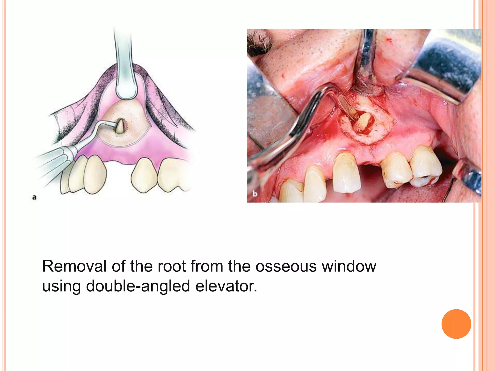 Removal of the root from the osseous window
using double-angled elevator.
 