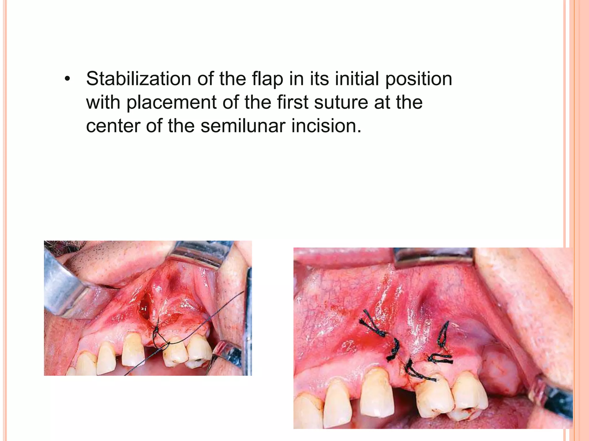• Stabilization of the flap in its initial position
with placement of the first suture at the
center of the semilunar incision.
 