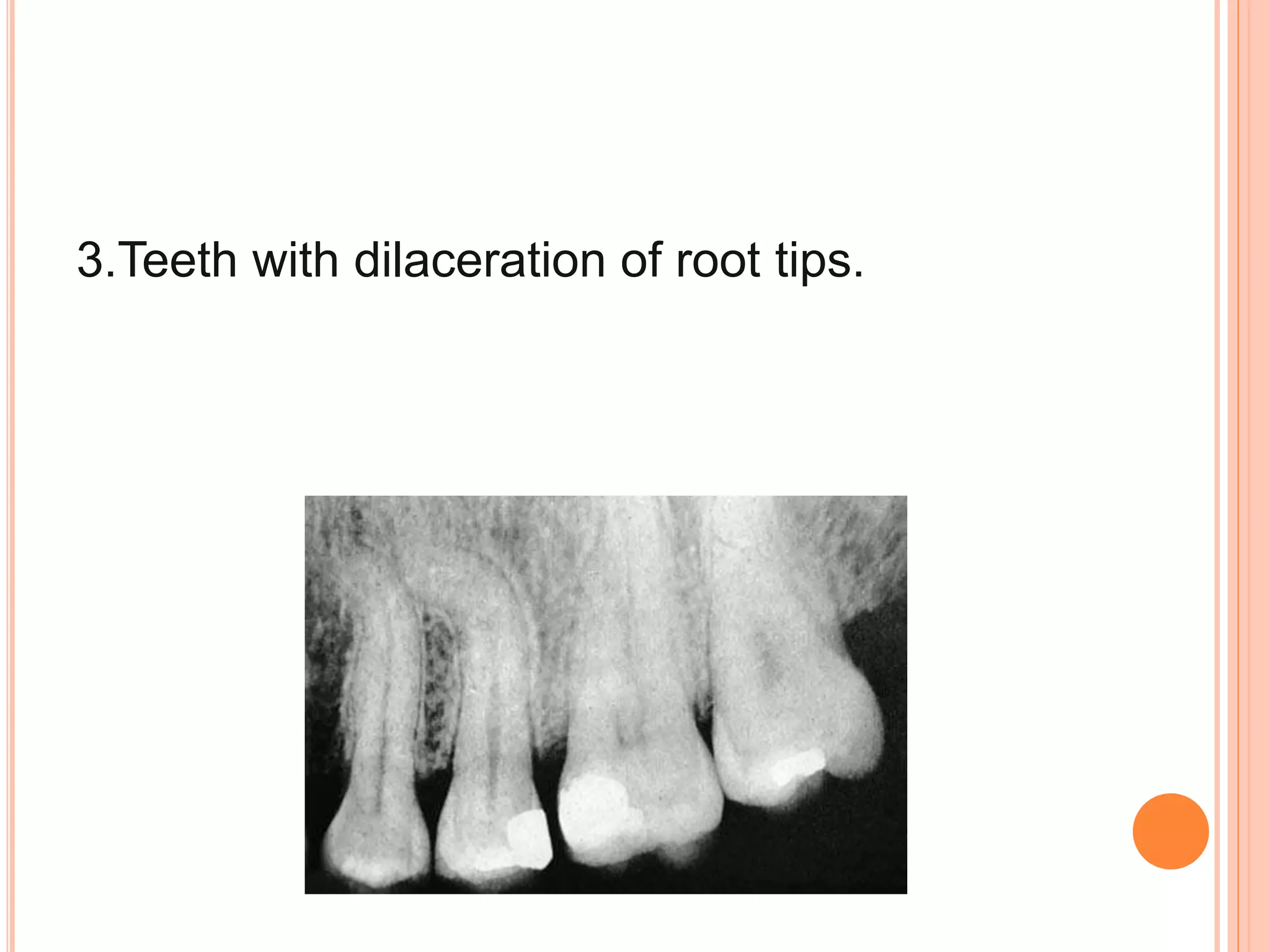 3.Teeth with dilaceration of root tips.
 