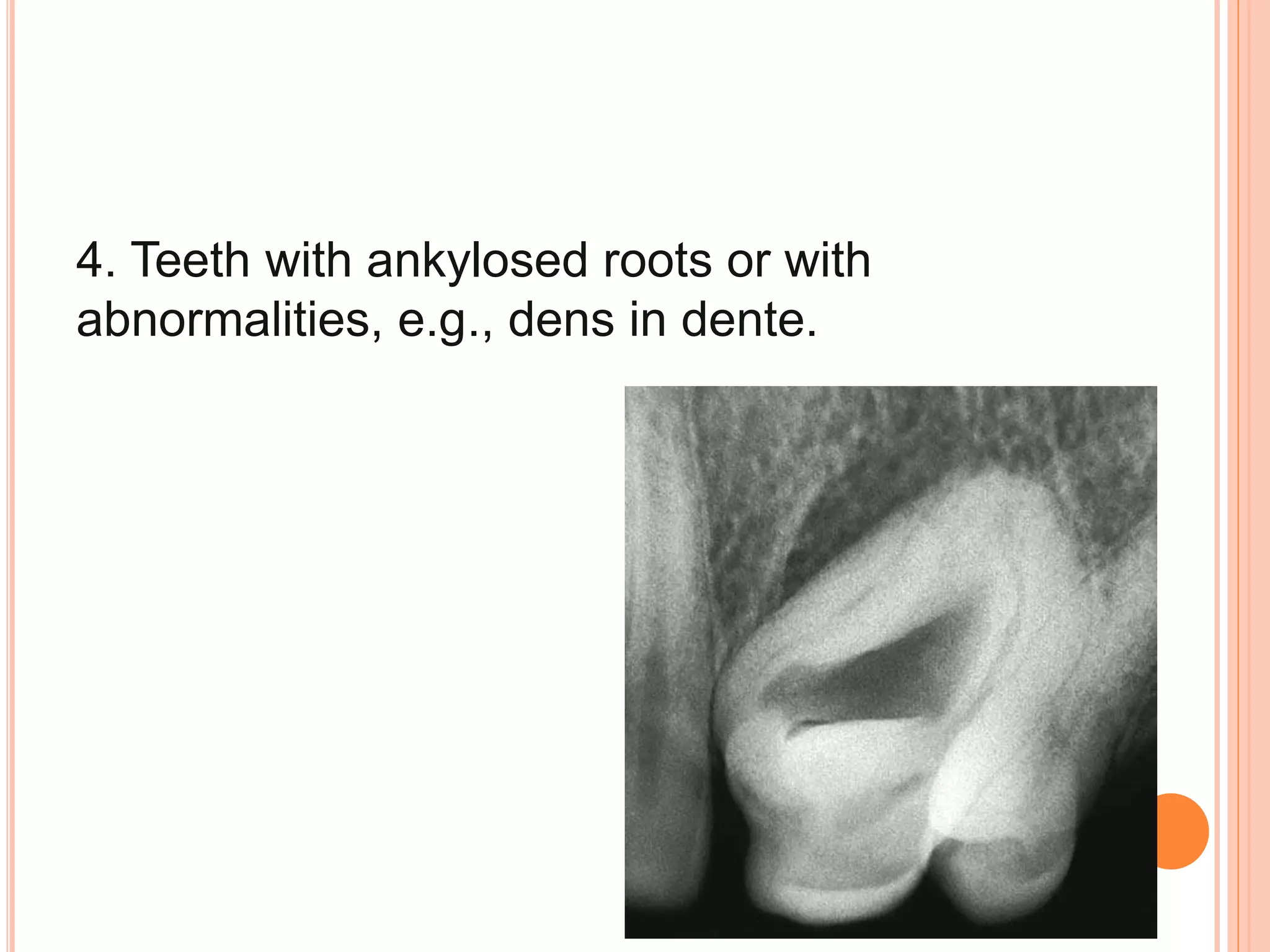 4. Teeth with ankylosed roots or with
abnormalities, e.g., dens in dente.
 
