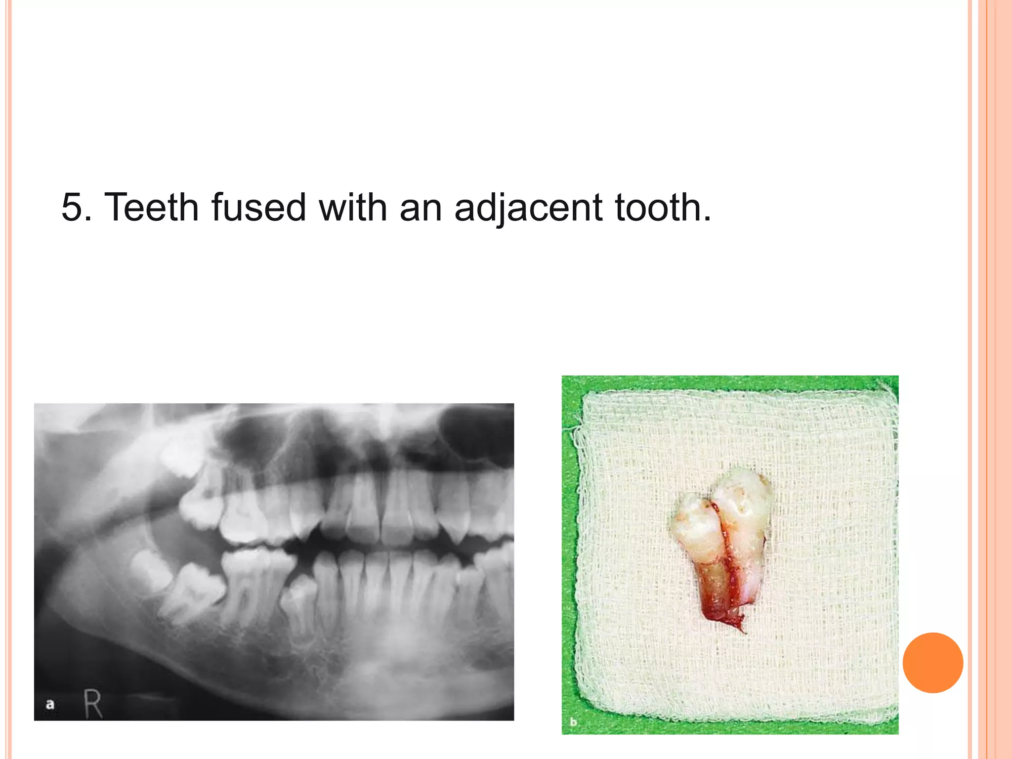 5. Teeth fused with an adjacent tooth.
 