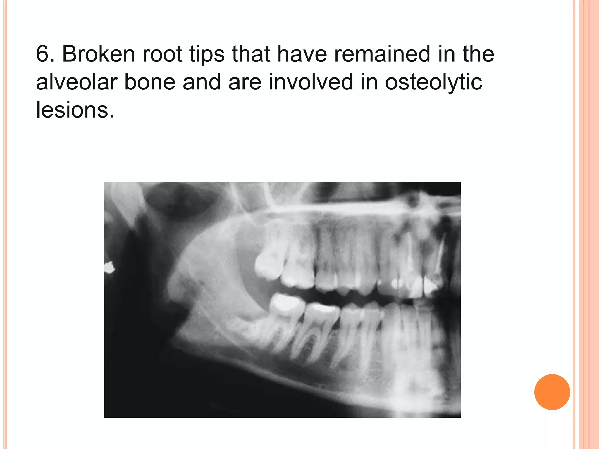 6. Broken root tips that have remained in the
alveolar bone and are involved in osteolytic
lesions.
 