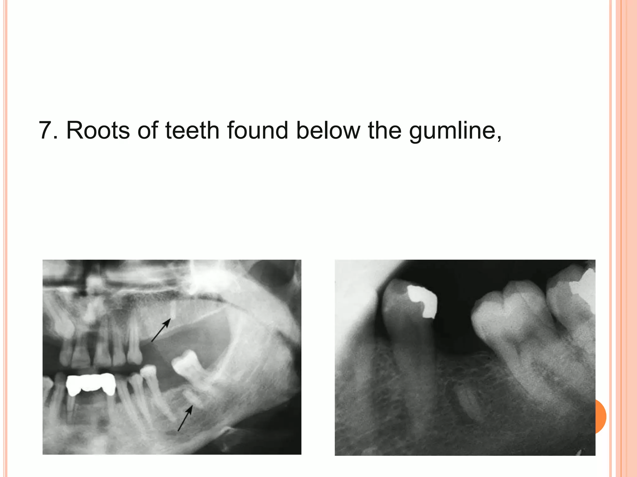 7. Roots of teeth found below the gumline,
 