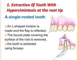Principles and steps of surgical tooth extraction | PPTX