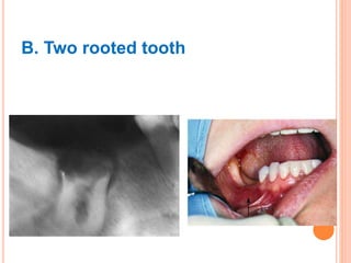 Principles and steps of surgical tooth extraction | PPTX