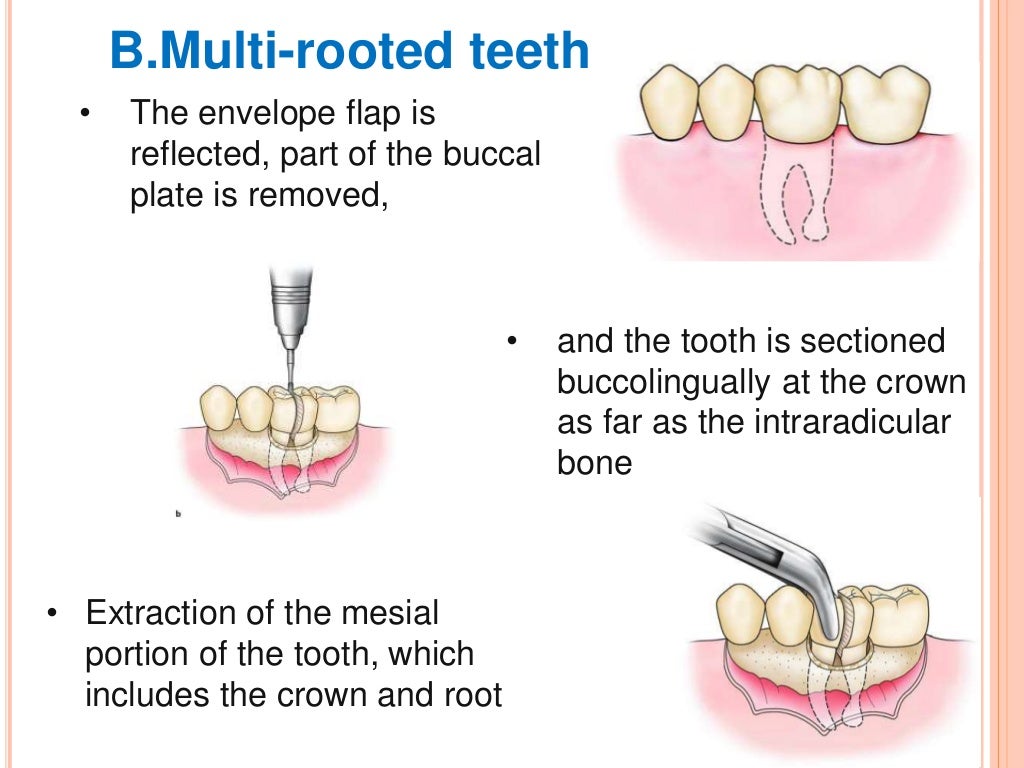 Principles and steps of surgical tooth extraction