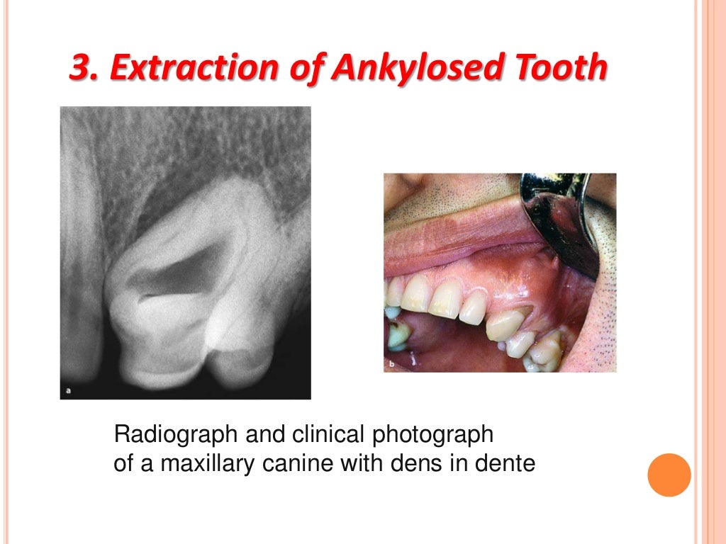Principles and steps of surgical tooth extraction