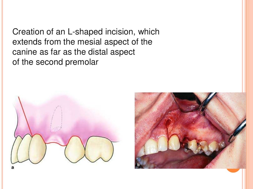 Principles and steps of surgical tooth extraction