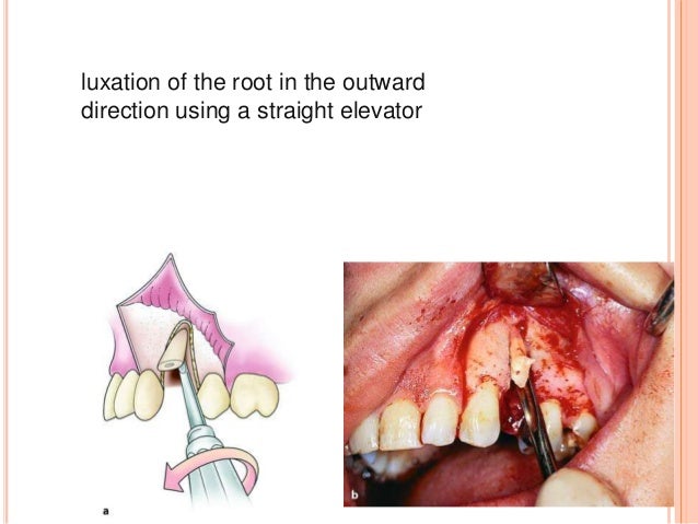 tooth luxation