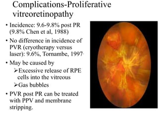 Pvr Optometry Principles and technique of pneumatic retinopexy (Dr. Avuru C.J).pptx