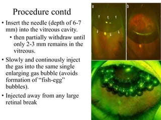 Procedure contd
• Insert the needle (depth of 6-7
mm) into the vitreous cavity.
• then partially withdraw until
only 2-3 mm remains in the
vitreous.
• Slowly and continously inject
the gas into the same single
enlarging gas bubble (avoids
formation of “fish-egg”
bubbles).
• Injected away from any large
retinal break
 