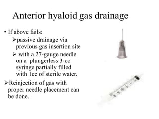 Anterior hyaloid gas drainage
• If above fails:
passive drainage via
previous gas insertion site
 with a 27-gauge needle
on a plungerless 3-cc
syringe partially filled
with 1cc of sterile water.
Reinjection of gas with
proper needle placement can
be done.
 
