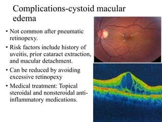 Complications-cystoid macular
edema
• Not common after pneumatic
retinopexy.
• Risk factors include history of
uveitis, prior cataract extraction,
and macular detachment.
• Can be reduced by avoiding
excessive retinopexy
• Medical treatment: Topical
steroidal and nonsteroidal anti-
inflammatory medications.
 