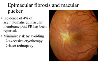 Epimacular fibrosis and macular
pucker
• Incidence of 4% of
asymptomatic epimacular
membrane post PR has been
reported.
• Minimize risk by avoiding
excessive cryotherapy
laser retinopexy
 