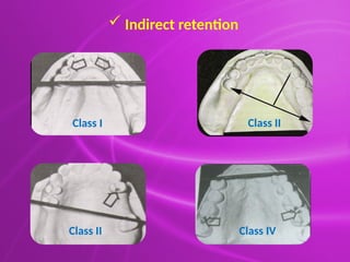 Indirect Retention In Rpd Principles & Designing of Removable partial denture.pptx