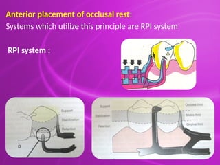 Principles & Designing of Removable partial denture.pptx