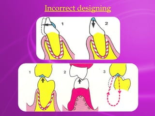Principles & Designing of Removable partial denture.pptx