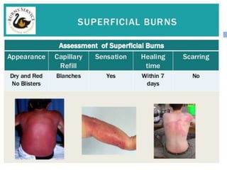 Principles in management of burns | PPTX
