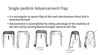 Principles In Plastic Surgery including skin grafting , flaps , wound ...
