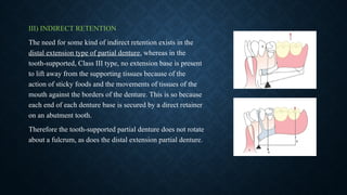 Example Indirect Retention In Rpd Principles in RPD Design and its importance in surveying | PPTX
