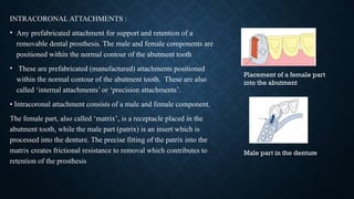 Internal Attachment In Rpd Principles in RPD Design and its importance in surveying | PPTX