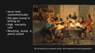 • Sever limb 
unanesthetically 
• Dip open stump in 
boiling oil 
• High mortality 
rate 
• Resulting stump is 
poorly suited 
Oil on board by an unknown artist, mid nineteenth century amputation 
 