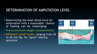 DETERMINATION OF AMPUTATION LEVEL 
• Determining the most distal level for 
amputation with a reasonable chance 
of healing can be challenging 
• Transcutaneous oxygen measurements 
• Different cutoff levels, ranging from 20 
to 40 mm Hg, for “good” healing 
potential 
 