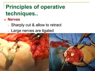 Principles of operative 
techniques.. 
 Nerves 
o Sharply cut & allow to retract 
o Large nerves are ligated 
 