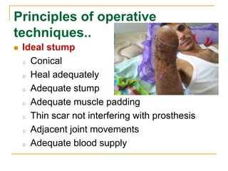 Principles of operative 
techniques.. 
 Ideal stump 
o Conical 
o Heal adequately 
o Adequate stump 
o Adequate muscle padding 
o Thin scar not interfering with prosthesis 
o Adjacent joint movements 
o Adequate blood supply 
 