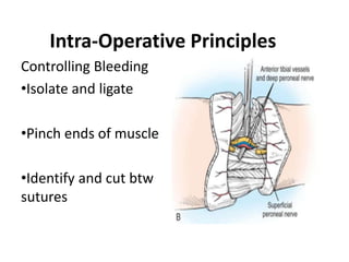 Intra-Operative Principles
Controlling Bleeding
•Isolate and ligate
•Pinch ends of muscle
•Identify and cut btw
sutures
 