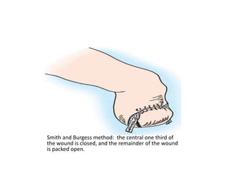 Smith and Burgess method: the central one third of
the wound is closed, and the remainder of the wound
is packed open.
 