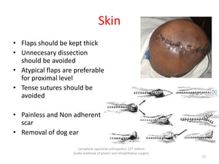 Skin
• Flaps should be kept thick
• Unnecesary dissection
should be avoided
• Atypical flaps are preferable
for proximal level
• Tense sutures should be
avoided
• Painless and Non adherent
scar
• Removal of dog ear
Campbells operative orthopedics 13th edition
Grabs textbook of plastic and rehabilitative surgery
11
 