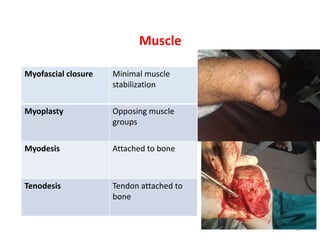 Muscle
Myofascial closure Minimal muscle
stabilization
Myoplasty Opposing muscle
groups
Myodesis Attached to bone
Tenodesis Tendon attached to
bone
12
 