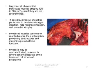 • Jaegers et al. showed that
transected muscles atrophy 40%
to 60% in 2 years if they are not
securely fixed.
• If possible, myodesis should be
performed to provide a stronger
insertion, help maximize strength,
and minimize atrophy
• Myodesed muscles continue to
counterbalance their antagonists,
preventing contractures and
maximizing residual limb
function.
• Myodesis may be
contraindicated, however, in
severe ischemia because of the
increased risk of wound
breakdown
Campbells operative orthopedics 13th
edition 13
 