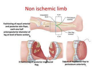 Non ischemic limb
Fashioning of equal anterior
and posterior skin flaps,
each one half
anteroposterior diameter of
leg at level of bone section.
Suture of myofascial flap to
periosteum anteriorly.
Fashioning of posterior myofascial
flap. 14
 