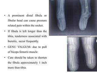 • A prominent distal fibula or
fibular head can cause pressure
related pain within the socket.
• If fibula is left longer than the
tibia, tenderness associated with
bursitis, occur frequently.
• GENU VALGUM- due to pull
of biceps femoris muscle
• Care should be taken to shorten
the fibula approximately 1 inch
more than tibia.
23
 