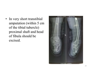 • In very short transtibial
amputation (within 5 cm
of the tibial tubercle)
proximal shaft and head
of fibula should be
excised.
24
 