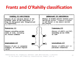 Frantz and O'Rahilly classification
Nomenclature for congenital skeletal limb deficiencies, a revision
of the Frantz and O'Rahilly classification, Robert L.et al
27
 