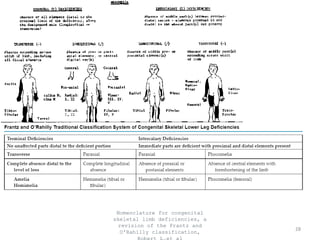 Nomenclature for congenital
skeletal limb deficiencies, a
revision of the Frantz and
O'Rahilly classification,
28
 