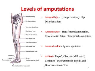Levels of amputations
• Around hip – Hemi-pelvectomy, Hip
Disarticulation
• Around knee –Transfemoral amputation,
Knee disarticulation Transtibial amputation
• Around ankle - Syme amputation
• At foot - Pirgof , Chopart (Mid tarsal)
Lisfranc (Tarsometatarsal), Boyd’s and
Disarticulation of toes
29
 