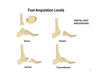 PARTIAL FOOT
AMPUTATIONS
30
 