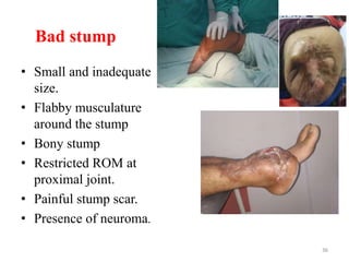 Bad stump
• Small and inadequate
size.
• Flabby musculature
around the stump
• Bony stump
• Restricted ROM at
proximal joint.
• Painful stump scar.
• Presence of neuroma.
36
 