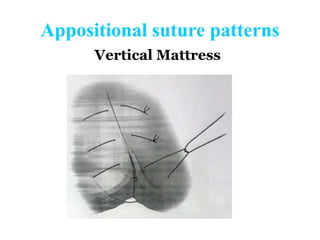 Appositional Pattern Principles of anastamosis in alimentary tract | PPTX