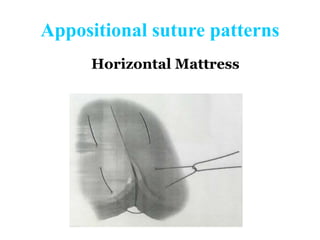 Appositional Pattern Principles of anastamosis in alimentary tract | PPTX