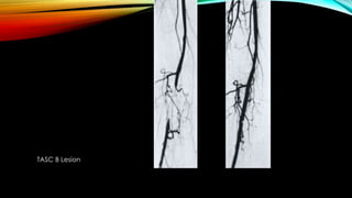 Principles of angioplasty -Endovascular Management of Peripheral ...