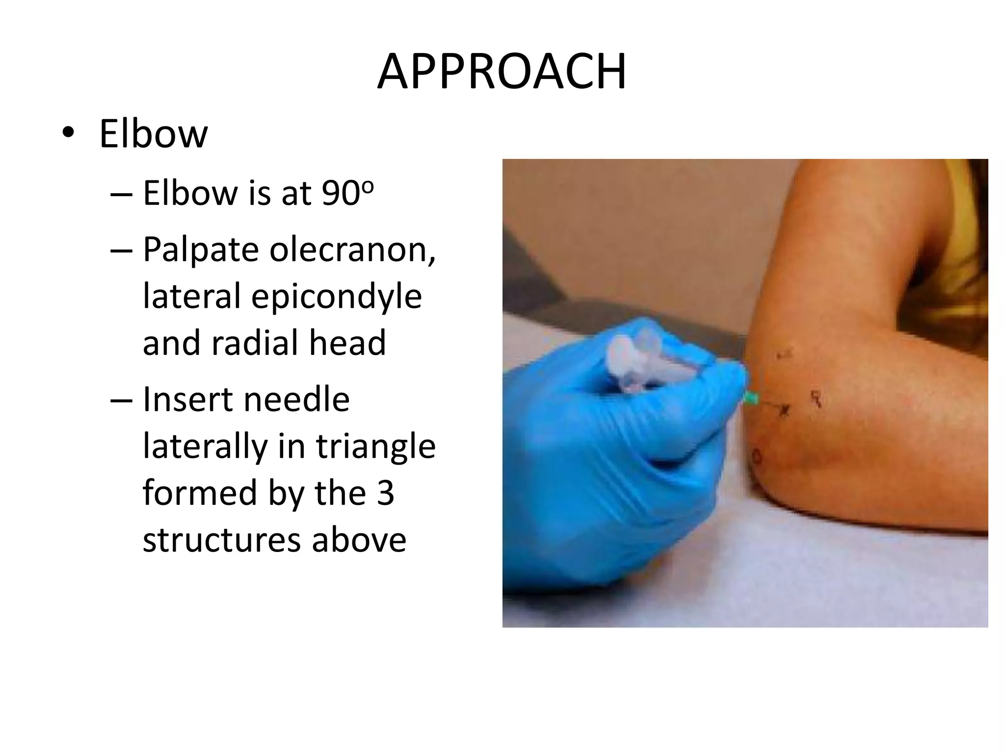 APPROACH
• Elbow
– Elbow is at 90o
– Palpate olecranon,
lateral epicondyle
and radial head
– Insert needle
laterally in triangle
formed by the 3
structures above
 